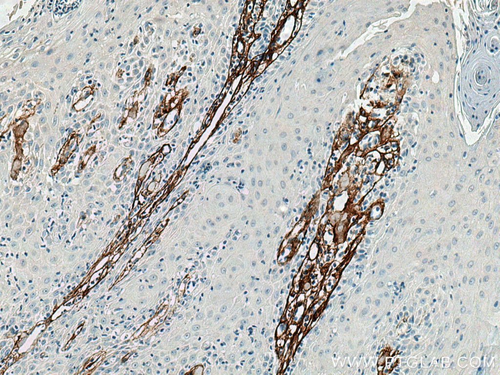 Immunohistochemistry (IHC) staining of human skin cancer tissue using Collagen Type III (N-terminal) Recombinant antibod (80009-1-RR)
