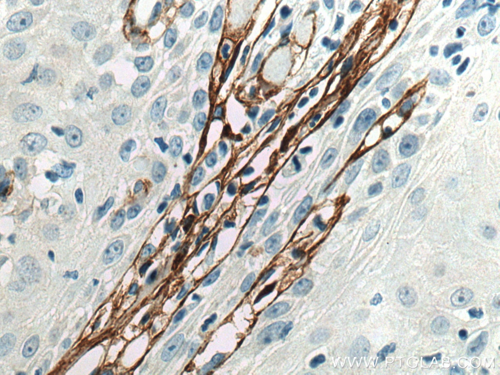 Immunohistochemistry (IHC) staining of human skin cancer tissue using Collagen Type III (N-terminal) Recombinant antibod (80009-1-RR)