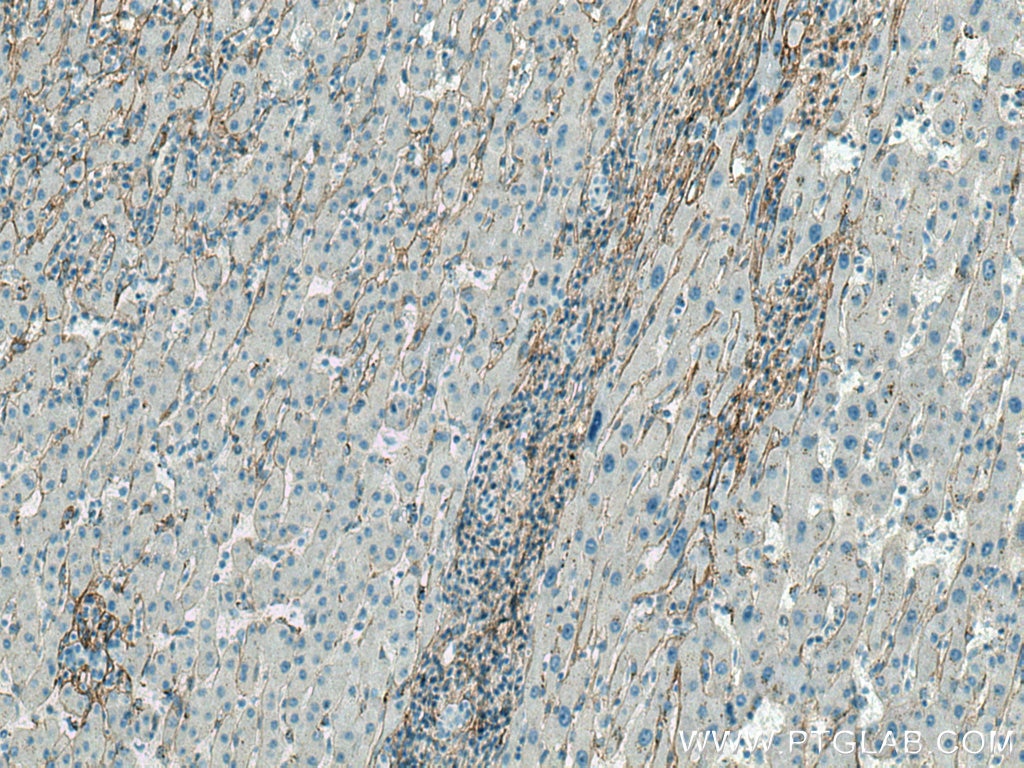 Immunohistochemistry (IHC) staining of human liver cancer tissue using Collagen Type III (N-terminal) Recombinant antibod (80009-1-RR)
