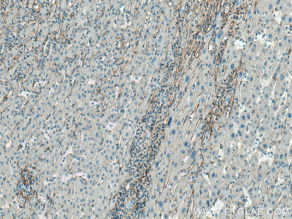 IHC staining of human liver cancer using 80009-1-RR