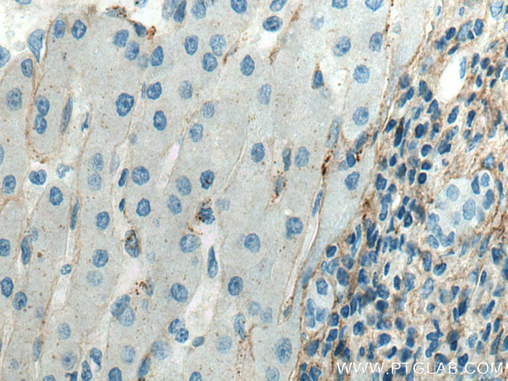 Immunohistochemistry (IHC) staining of human liver cancer tissue using Collagen Type III (N-terminal) Recombinant antibod (80009-1-RR)