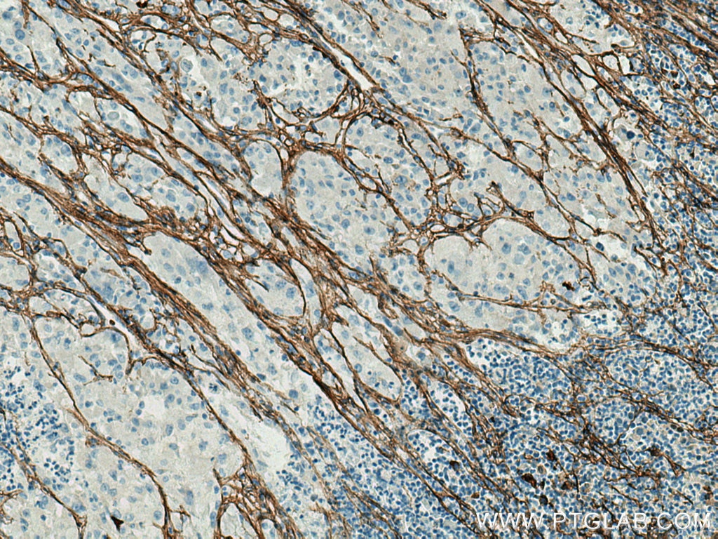 Immunohistochemistry (IHC) staining of human liver cancer tissue using Collagen Type III (N-terminal) Recombinant antibod (80009-1-RR)