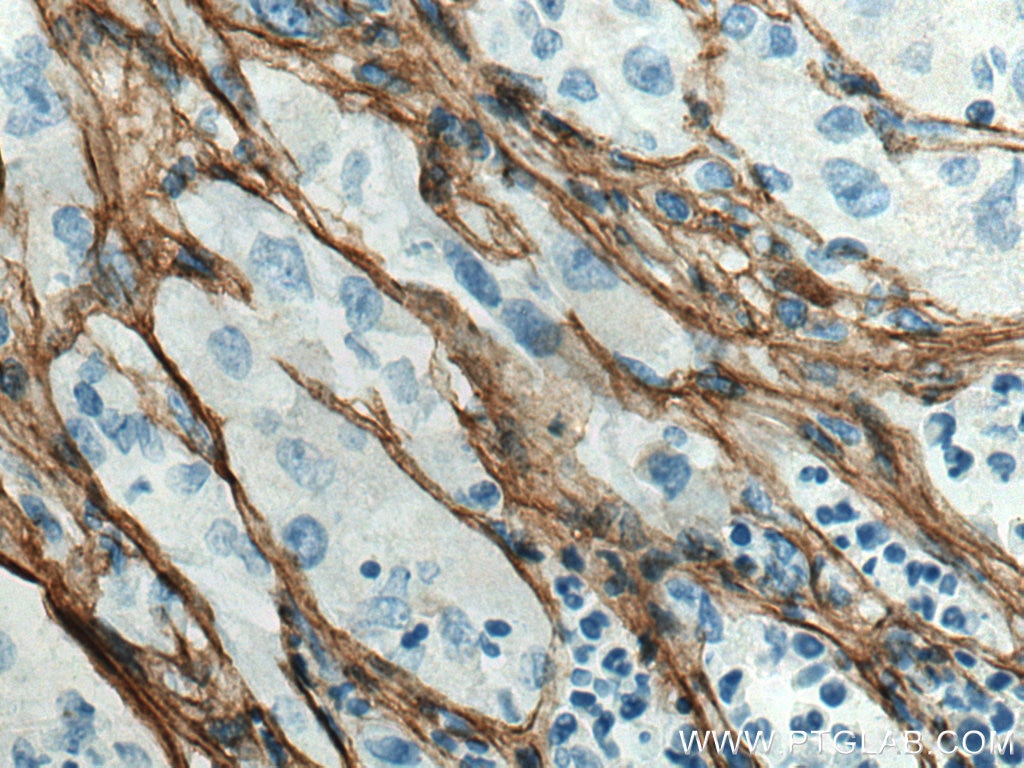 Immunohistochemistry (IHC) staining of human liver cancer tissue using Collagen Type III (N-terminal) Recombinant antibod (80009-1-RR)