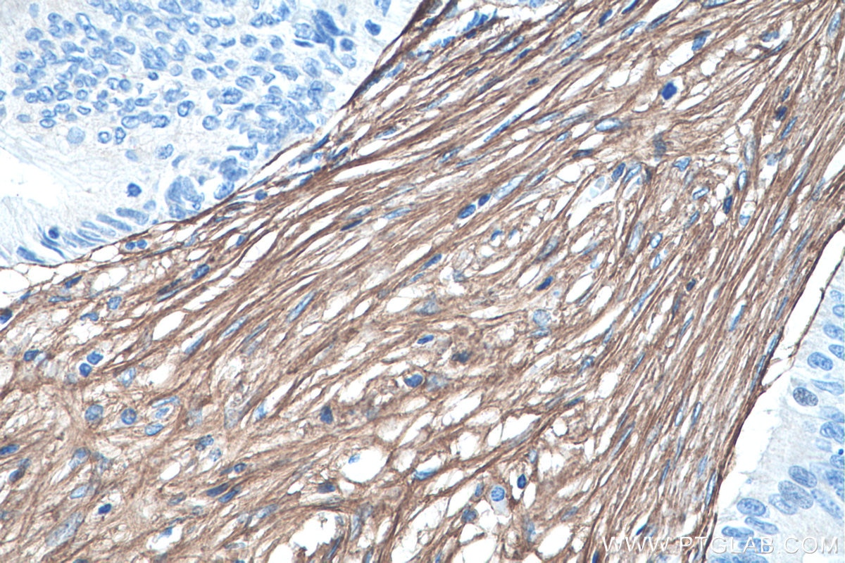 Immunohistochemistry (IHC) staining of human pancreas cancer tissue using Collagen Type III (N-terminal) Recombinant antibod (80009-1-RR)