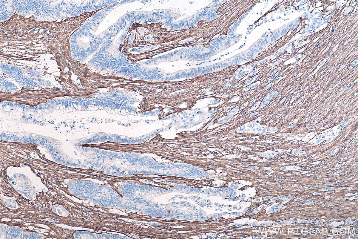 Immunohistochemistry (IHC) staining of human colon cancer tissue using Collagen Type III (N-terminal) Recombinant antibod (80009-1-RR)