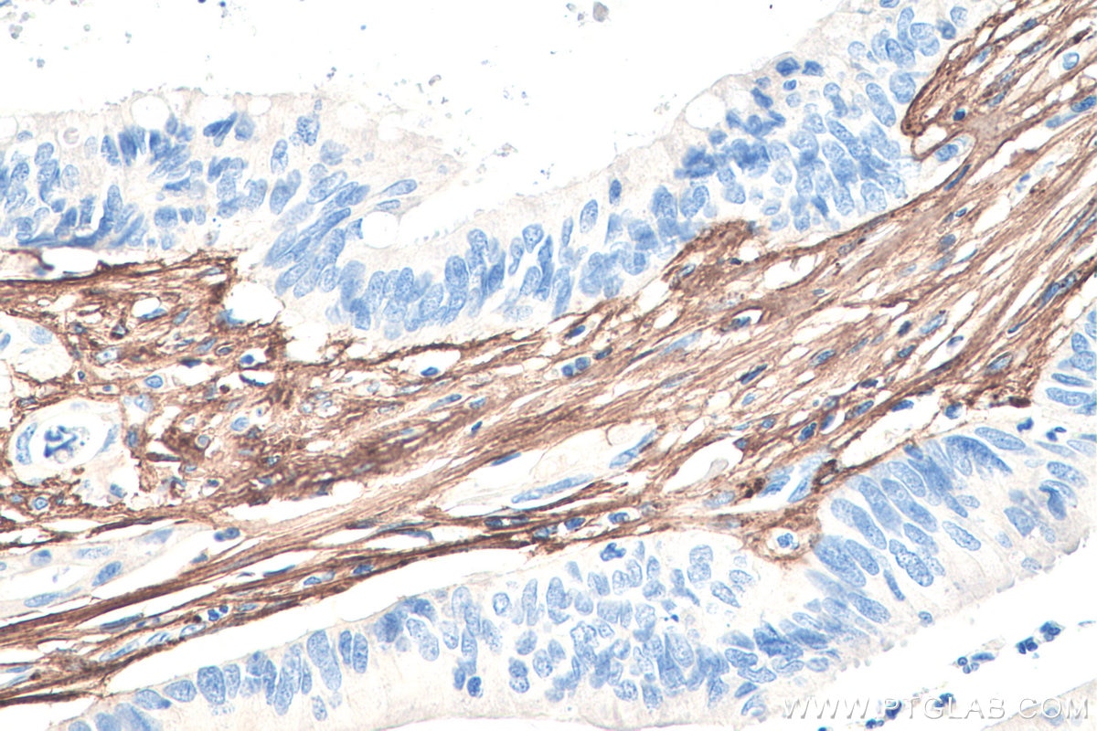 Immunohistochemistry (IHC) staining of human colon cancer tissue using Collagen Type III (N-terminal) Recombinant antibod (80009-1-RR)