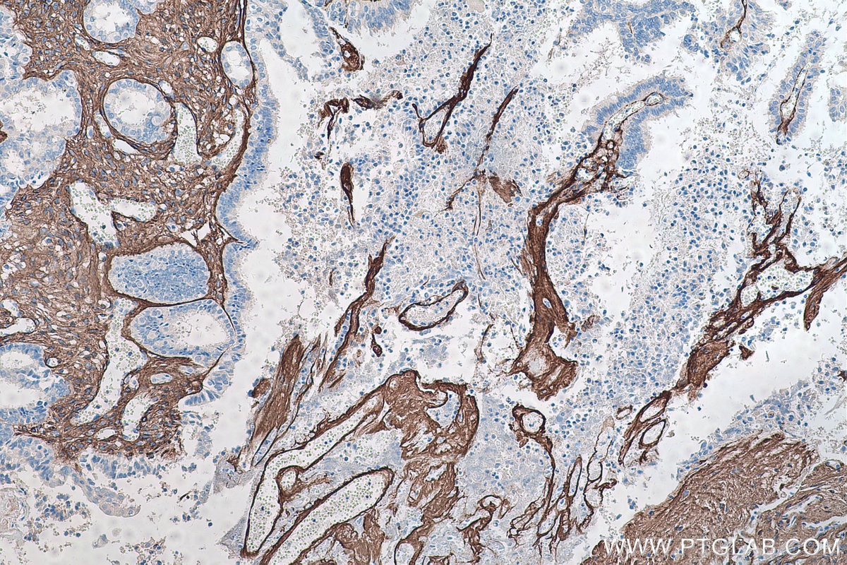 Immunohistochemistry (IHC) staining of human ovary tumor tissue using Collagen Type III (N-terminal) Recombinant antibod (80009-1-RR)