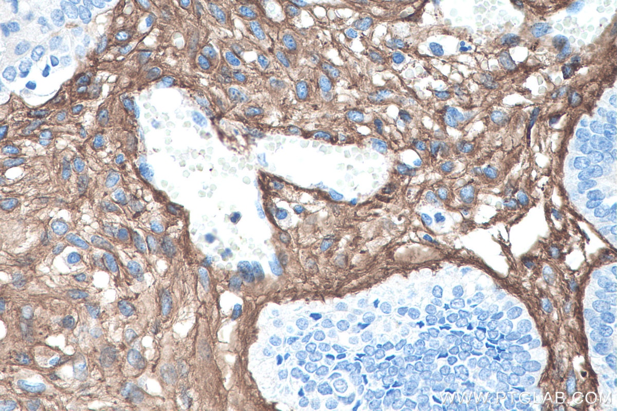 Immunohistochemistry (IHC) staining of human ovary tumor tissue using Collagen Type III (N-terminal) Recombinant antibod (80009-1-RR)