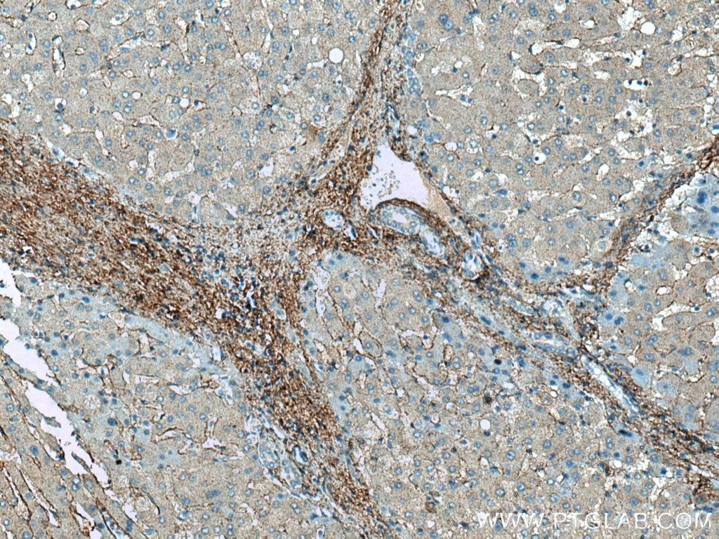 Immunohistochemistry (IHC) staining of human liver tissue using Collagen Type VI Polyclonal antibody (17023-1-AP)