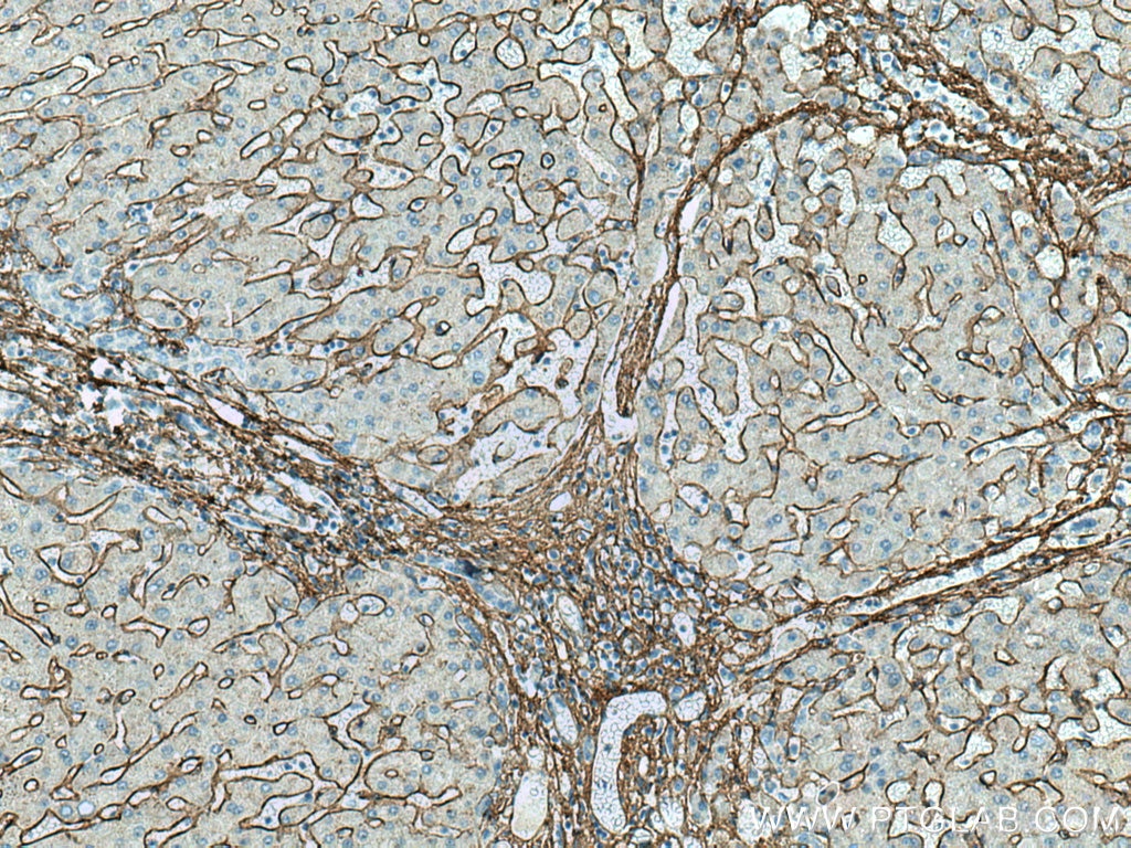 Immunohistochemistry (IHC) staining of human hepatocirrhosis tissue using Collagen Type VI Polyclonal antibody (17023-1-AP)