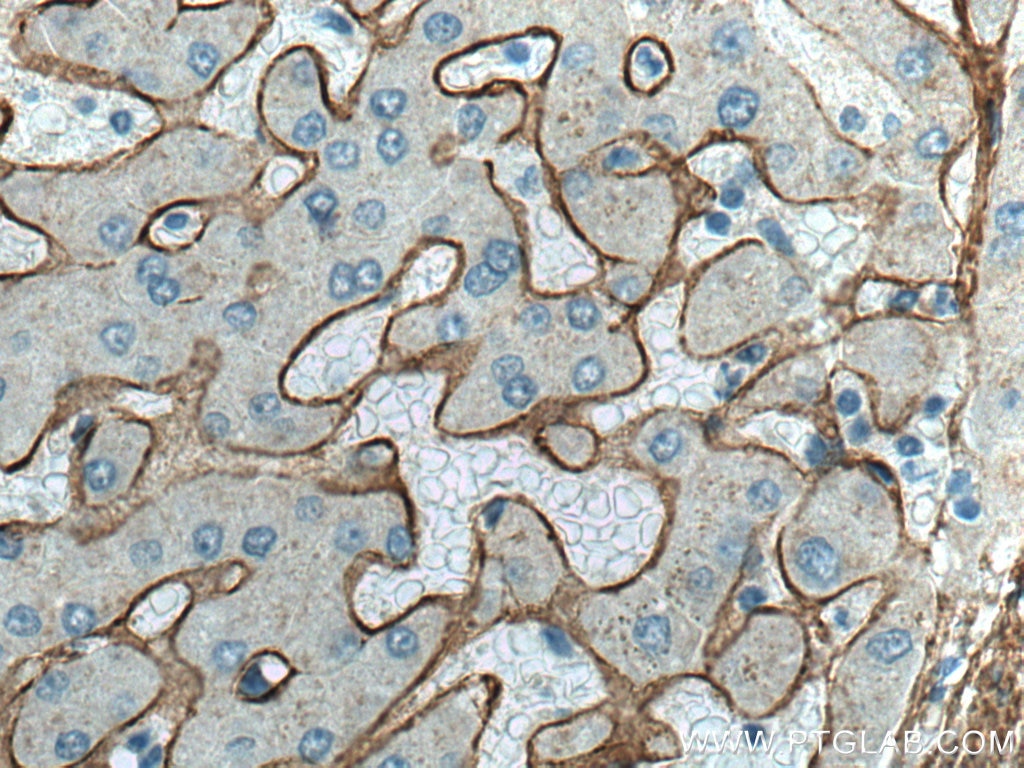 Immunohistochemistry (IHC) staining of human hepatocirrhosis tissue using Collagen Type VI Polyclonal antibody (17023-1-AP)