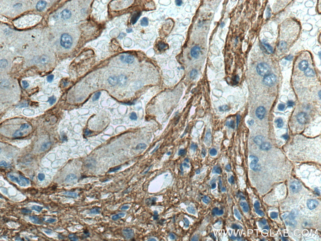 Immunohistochemistry (IHC) staining of human hepatocirrhosis tissue using Collagen Type VI Polyclonal antibody (17023-1-AP)