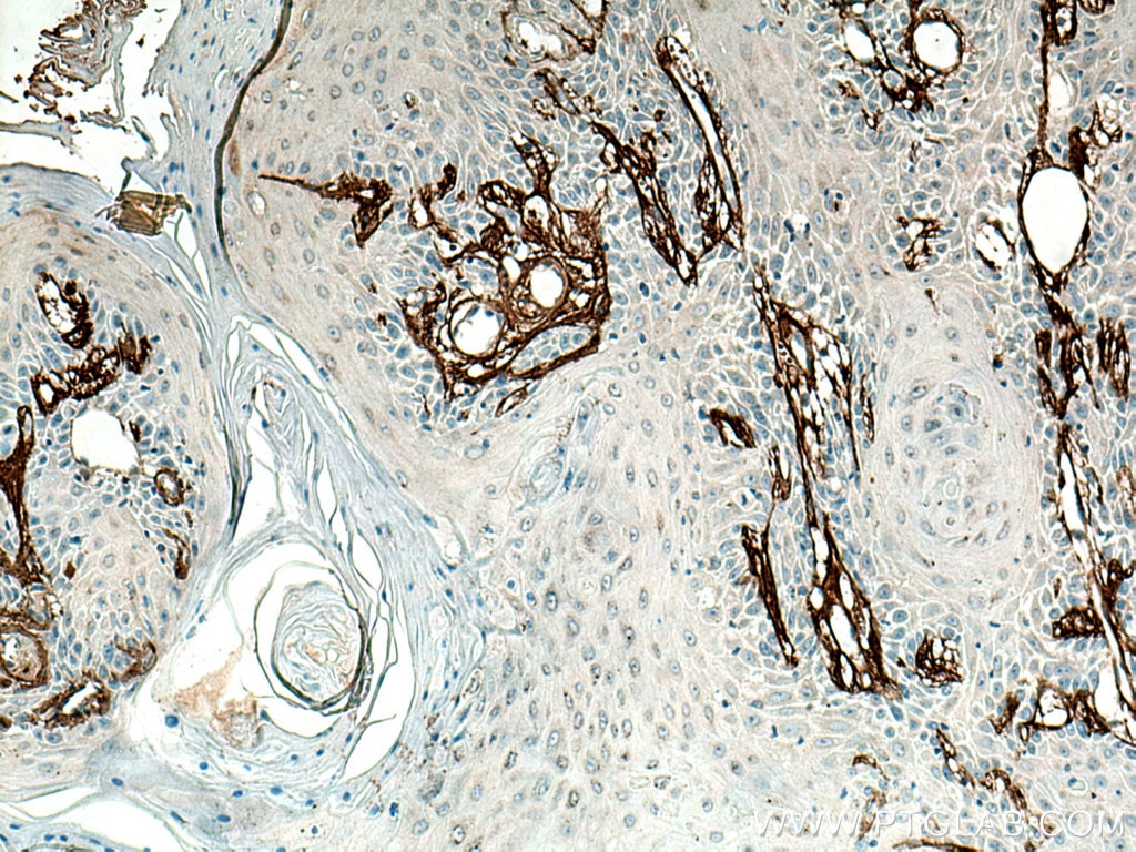 Immunohistochemistry (IHC) staining of human skin cancer tissue using Collagen Type VI Polyclonal antibody (17023-1-AP)