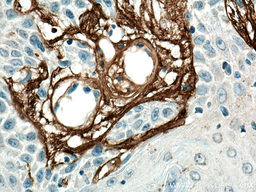 Immunohistochemistry (IHC) staining of human skin cancer tissue using Collagen Type VI Polyclonal antibody (17023-1-AP)