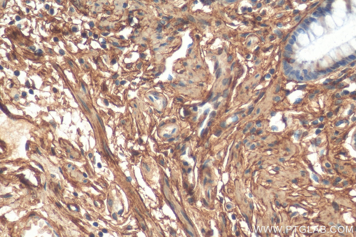 Immunohistochemistry (IHC) staining of human colon tissue using Collagen Type VI Polyclonal antibody (17023-1-AP)