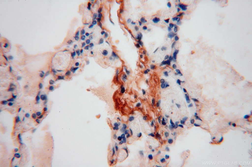 Immunohistochemistry (IHC) staining of human lung tissue using Collagen Type VI Polyclonal antibody (17023-1-AP)