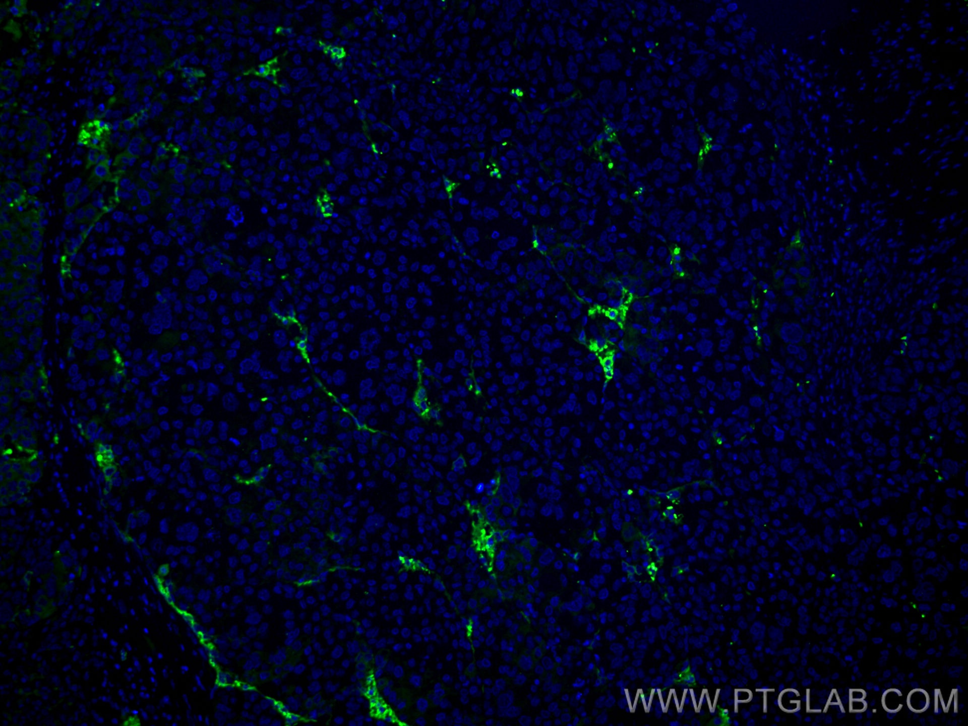 Immunofluorescence (IF) / fluorescent staining of human liver cancer tissue using Collagen Type VI  Monoclonal antibody (66824-1-Ig)