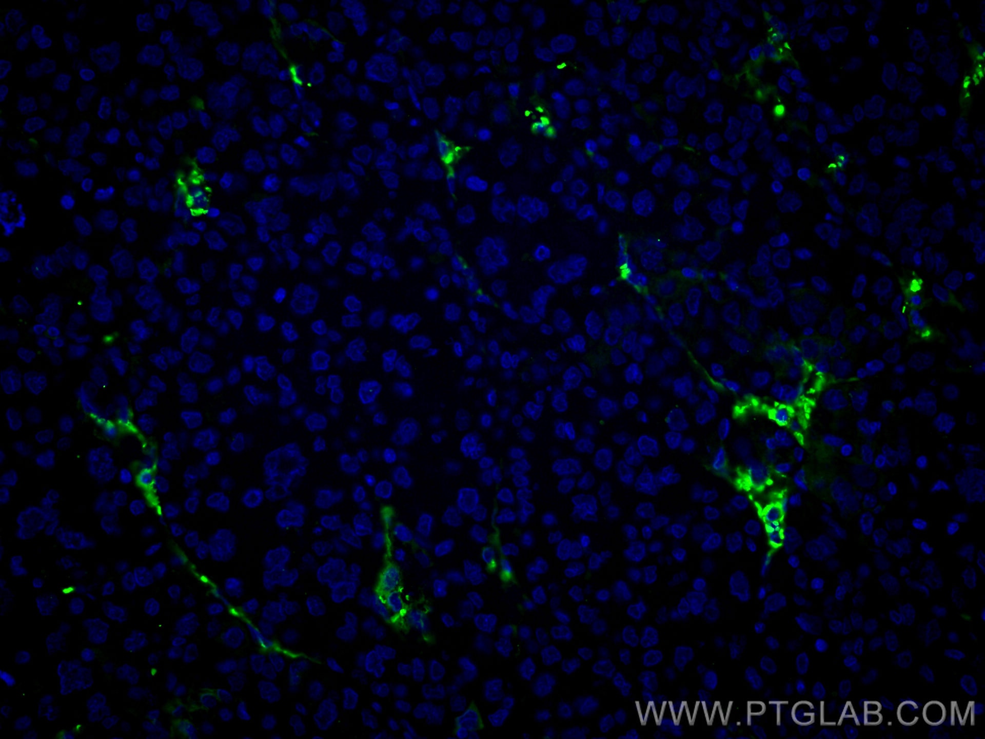Immunofluorescence (IF) / fluorescent staining of human liver cancer tissue using Collagen Type VI  Monoclonal antibody (66824-1-Ig)