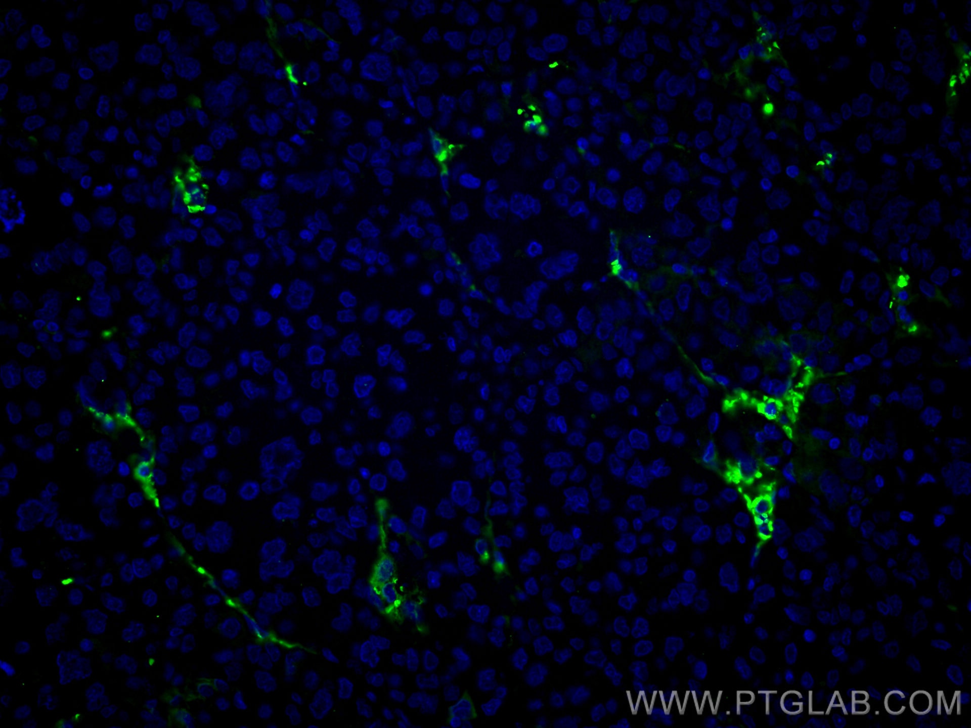 Immunofluorescence (IF) / fluorescent staining of human liver cancer tissue using COL6A1 Monoclonal antibody (66824-1-Ig)