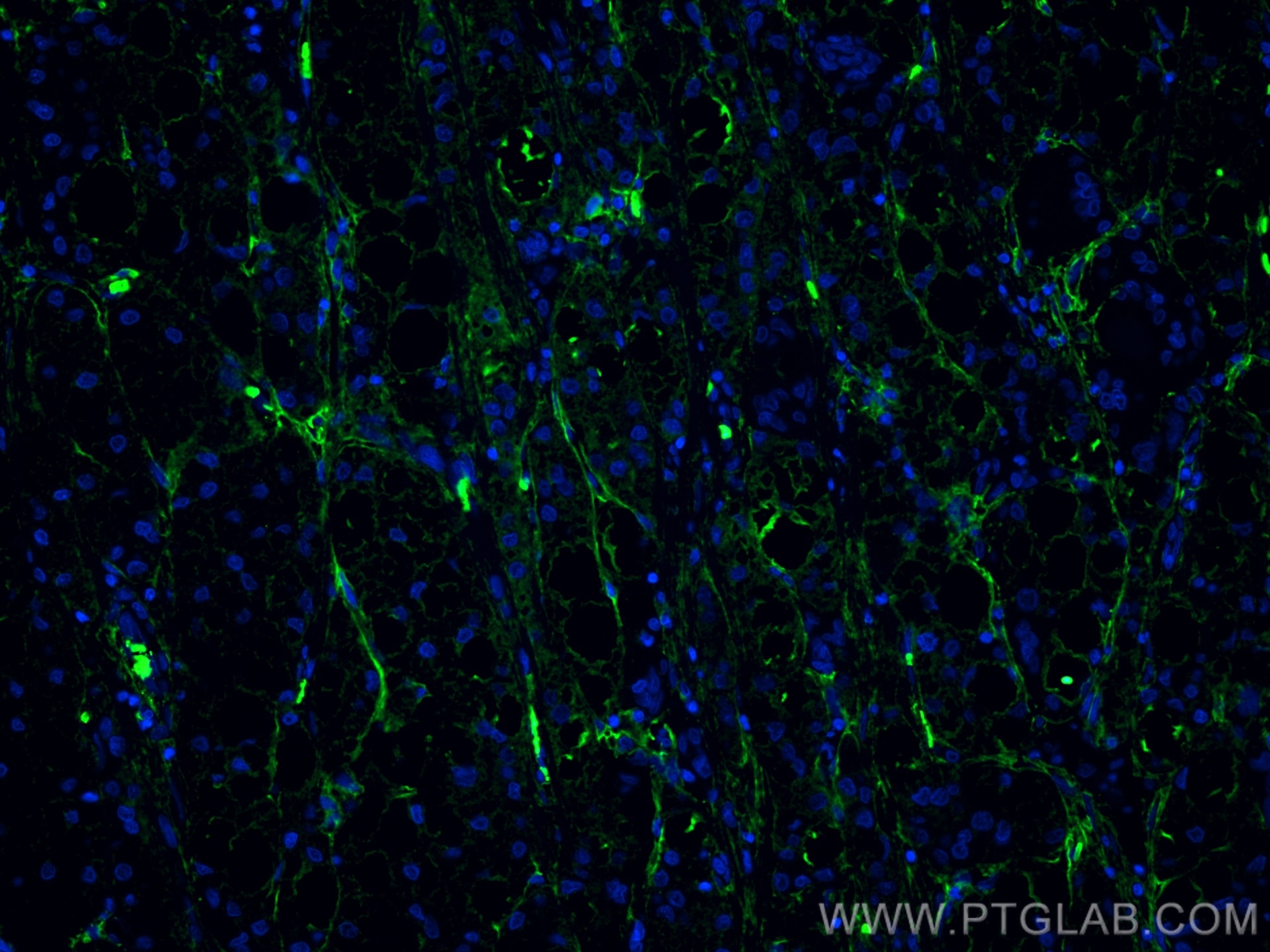 Immunofluorescence (IF) / fluorescent staining of human liver cancer tissue using COL6A1 Monoclonal antibody (66824-1-Ig)