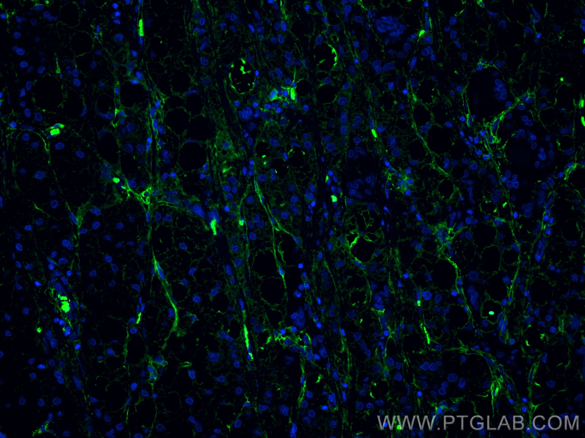 Immunofluorescence (IF) / fluorescent staining of human liver cancer tissue using Collagen Type VI  Monoclonal antibody (66824-1-Ig)