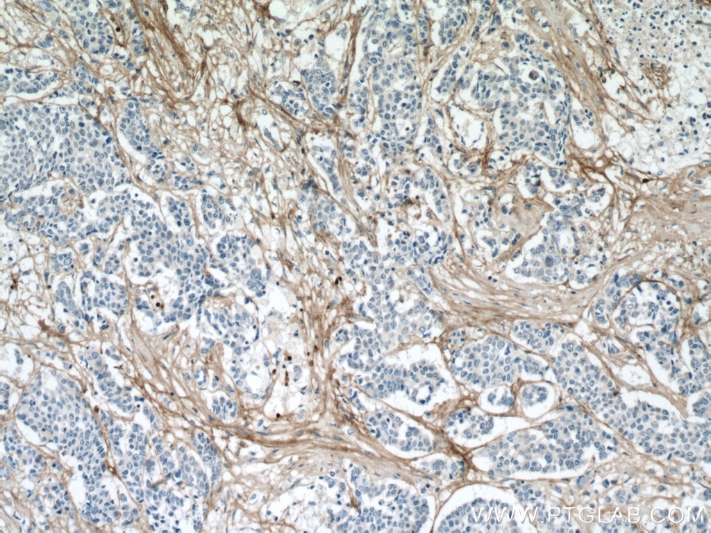 IHC staining of human colon cancer using 66824-1-Ig