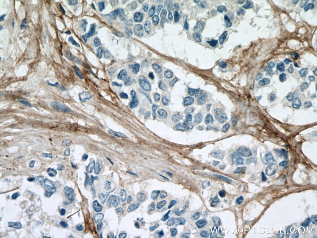 Immunohistochemistry (IHC) staining of human colon cancer tissue using Collagen Type VI  Monoclonal antibody (66824-1-Ig)