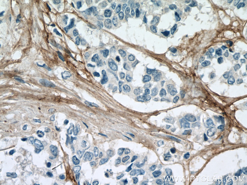 Immunohistochemistry (IHC) staining of human colon cancer tissue using COL6A1 Monoclonal antibody (66824-1-Ig)