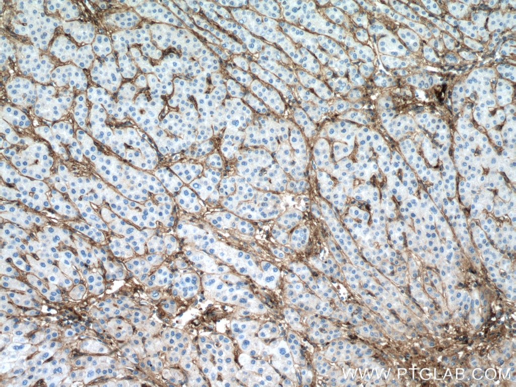 Immunohistochemistry (IHC) staining of human liver cancer tissue using Collagen Type VI  Monoclonal antibody (66824-1-Ig)