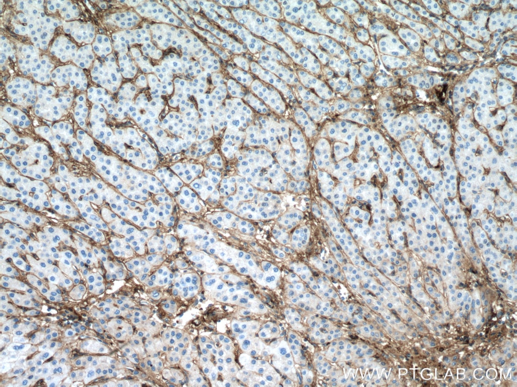 Immunohistochemistry (IHC) staining of human liver cancer tissue using COL6A1 Monoclonal antibody (66824-1-Ig)