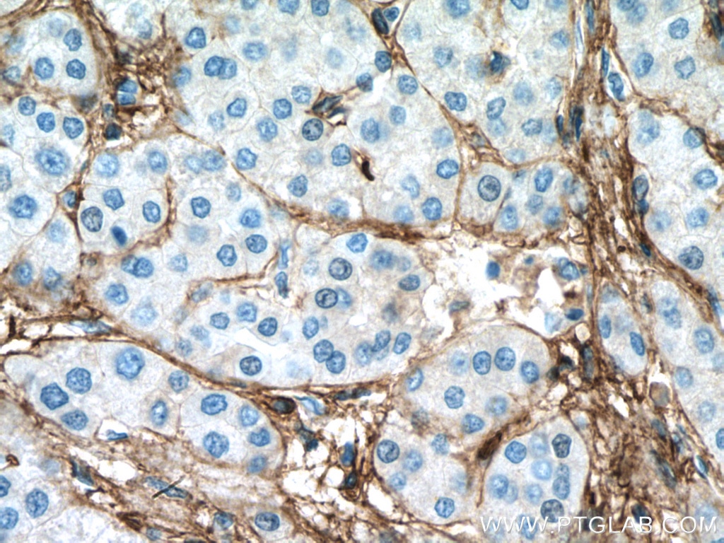 Immunohistochemistry (IHC) staining of human liver cancer tissue using Collagen Type VI  Monoclonal antibody (66824-1-Ig)