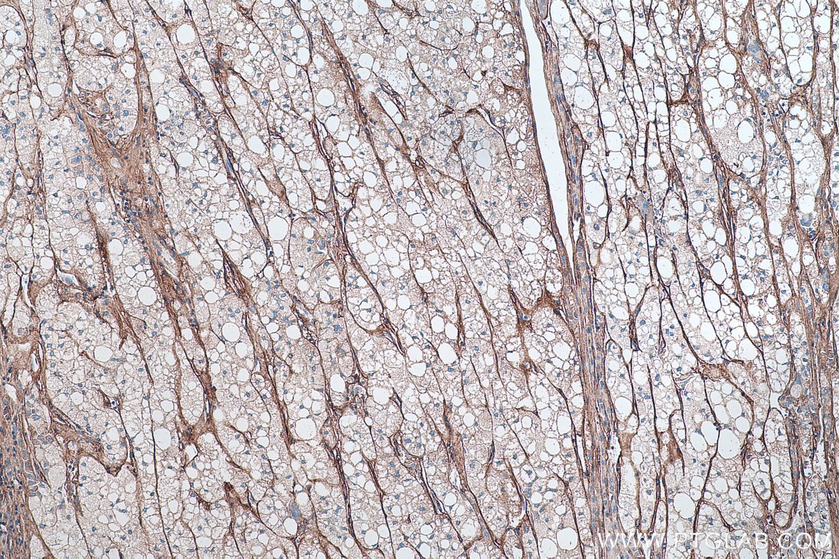 Immunohistochemistry (IHC) staining of human liver cancer tissue using Collagen Type VI Polyclonal antibody (14853-1-AP)
