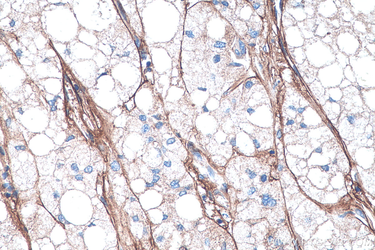 Immunohistochemistry (IHC) staining of human liver cancer tissue using Collagen Type VI Polyclonal antibody (14853-1-AP)