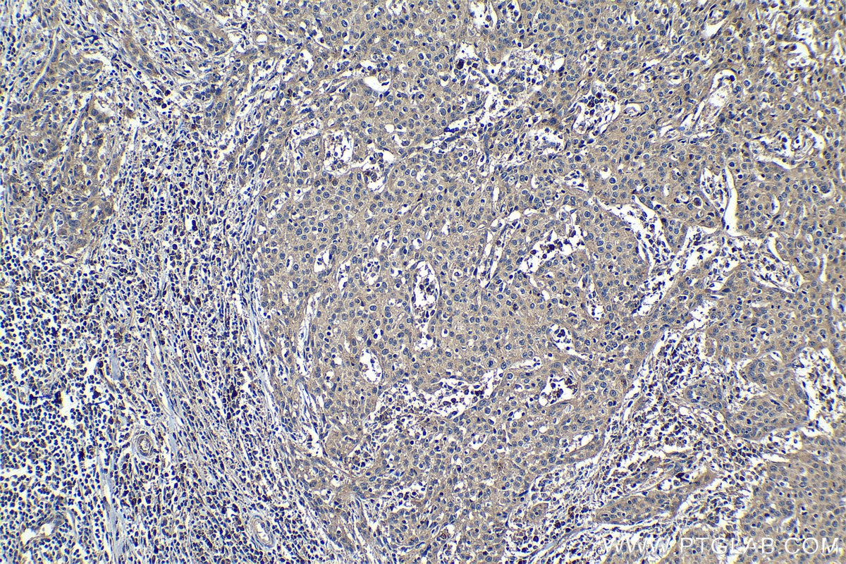 Immunohistochemistry (IHC) staining of human cervical cancer tissue using Collagen Type VI Polyclonal antibody (19798-1-AP)
