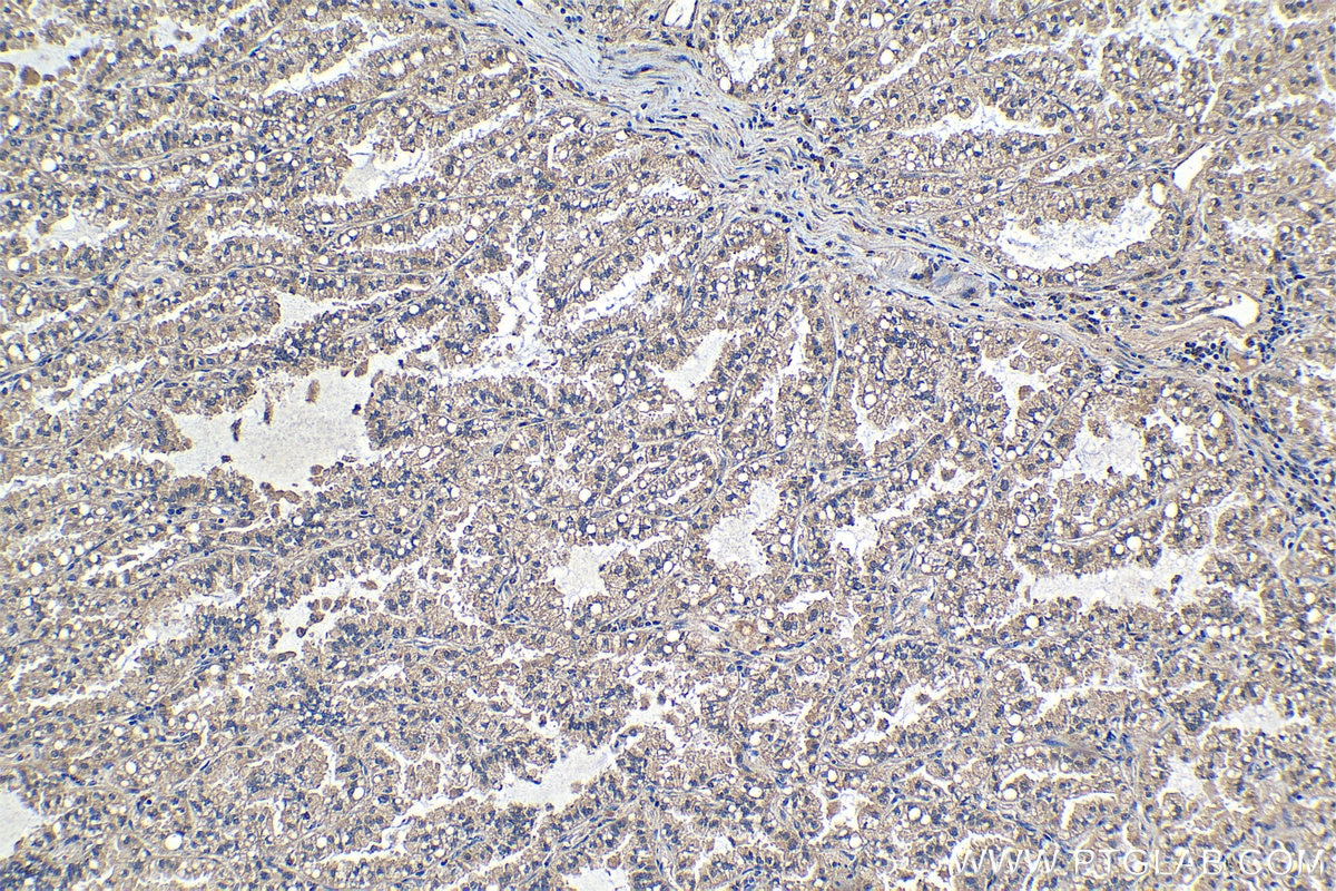 Immunohistochemistry (IHC) staining of human lung cancer tissue using Collagen Type VI Polyclonal antibody (19798-1-AP)