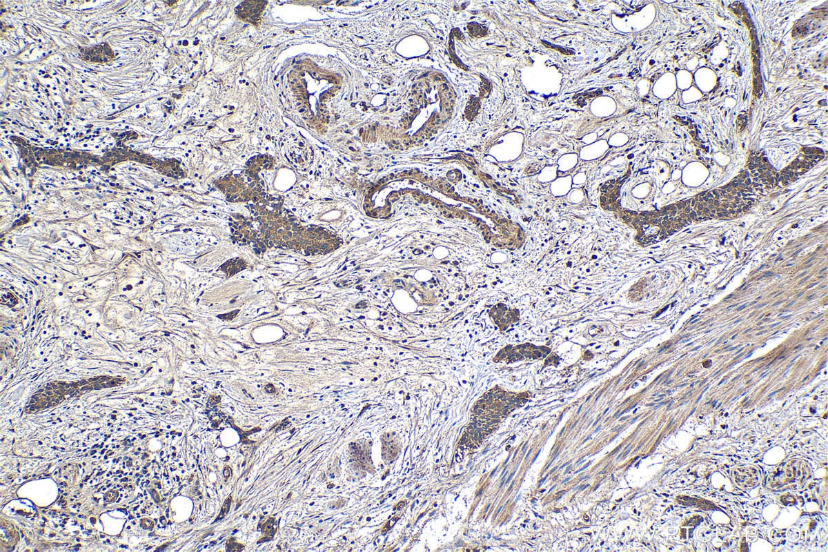Immunohistochemistry (IHC) staining of human urothelial carcinoma tissue using Collagen Type VI Polyclonal antibody (19798-1-AP)
