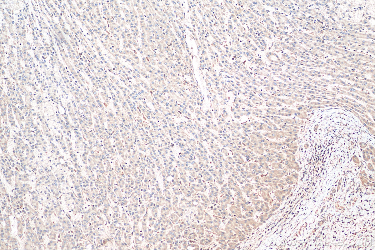 Immunohistochemistry (IHC) staining of human liver cancer tissue using COMMD1 Polyclonal antibody (11938-1-AP)