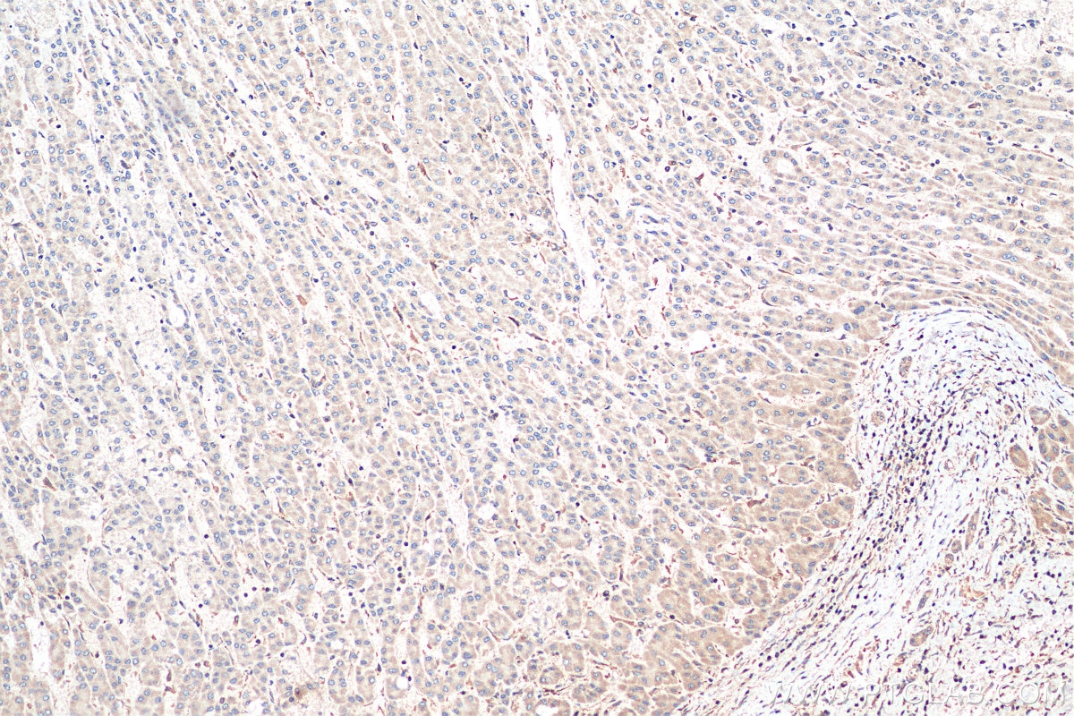 IHC staining of human liver cancer using 11938-1-AP