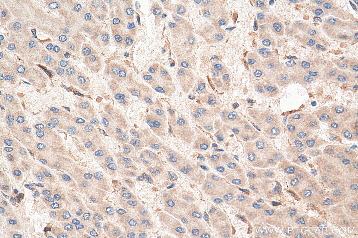 Immunohistochemistry (IHC) staining of human liver cancer tissue using COMMD1 Polyclonal antibody (11938-1-AP)