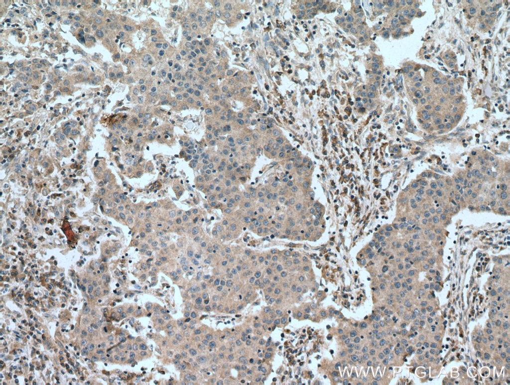 Immunohistochemistry (IHC) staining of human breast cancer tissue using COMMD1 Monoclonal antibody (67016-1-Ig)