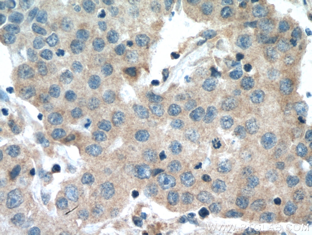 Immunohistochemistry (IHC) staining of human breast cancer tissue using COMMD1 Monoclonal antibody (67016-1-Ig)