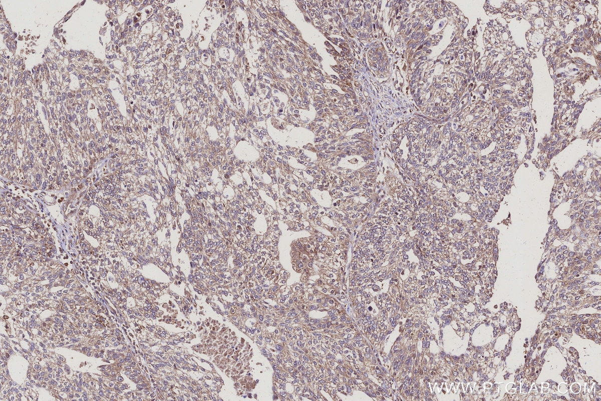 Immunohistochemistry (IHC) staining of human ovary cancer tissue using COMMD5 Monoclonal antibody (67043-1-Ig)