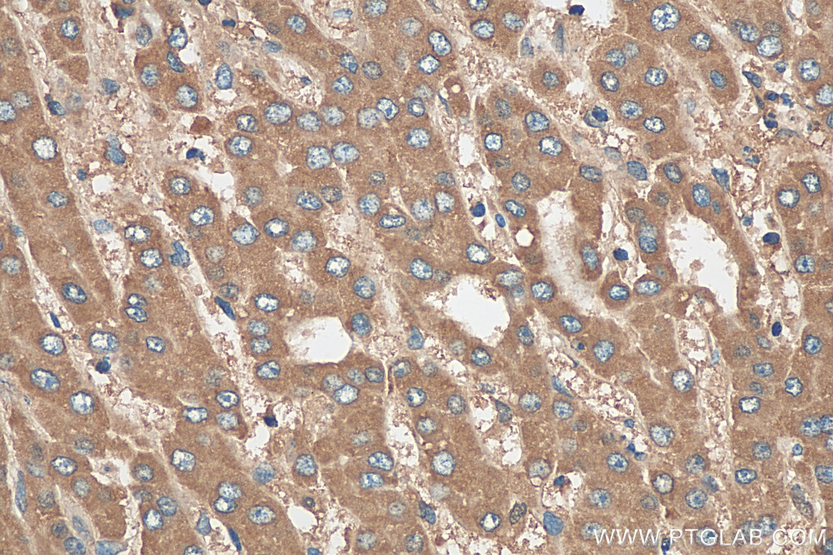Immunohistochemistry (IHC) staining of human liver cancer tissue using COMP Polyclonal antibody (28369-1-AP)
