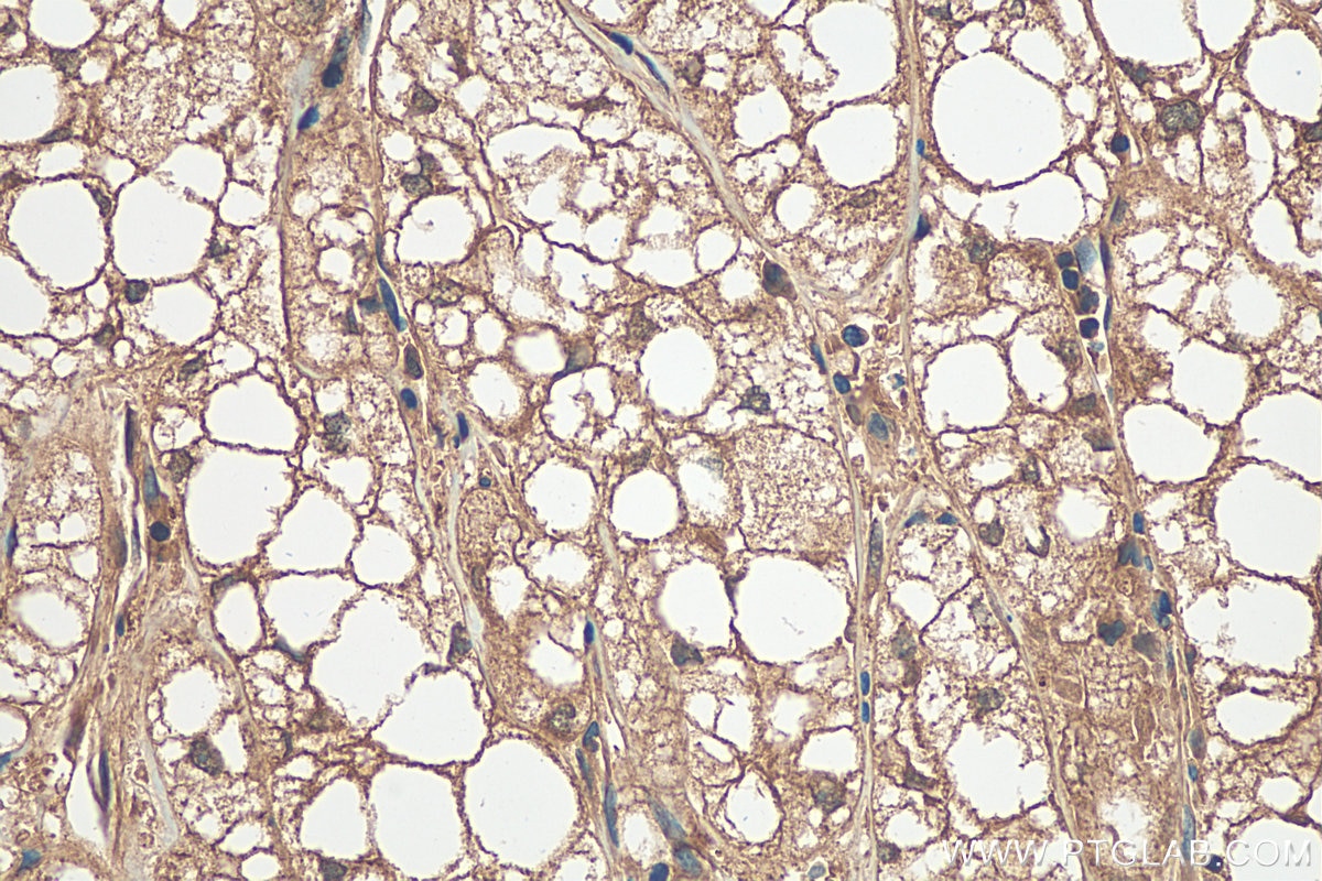 Immunohistochemistry (IHC) staining of human liver cancer tissue using COMP Polyclonal antibody (28369-1-AP)