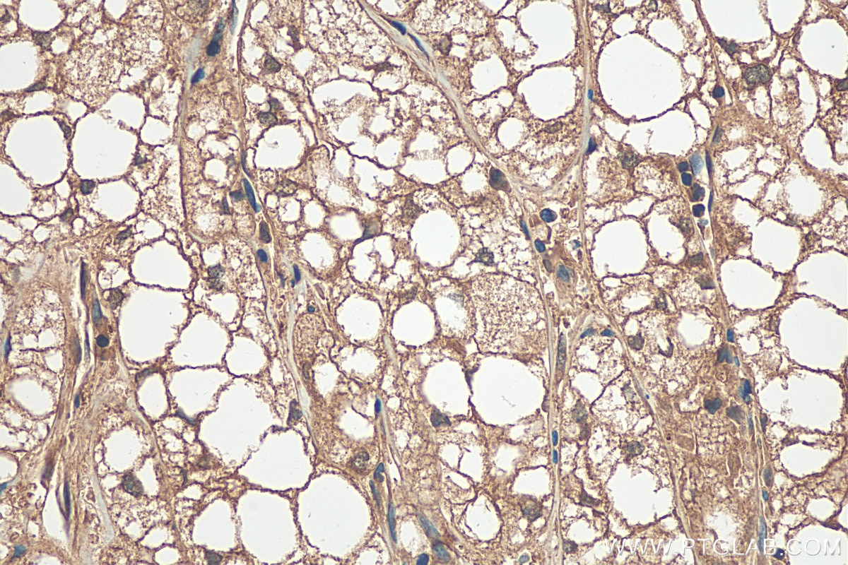 IHC staining of human liver cancer using 28369-1-AP