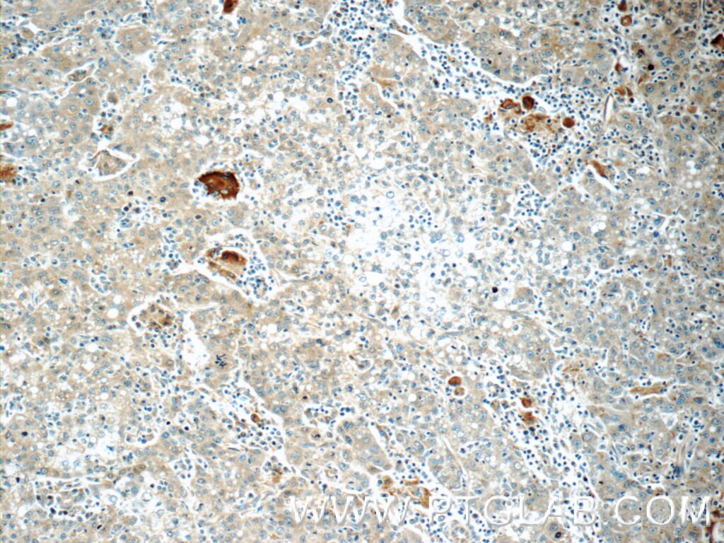 Immunohistochemistry (IHC) staining of human liver cancer tissue using COPE Polyclonal antibody (11457-1-AP)