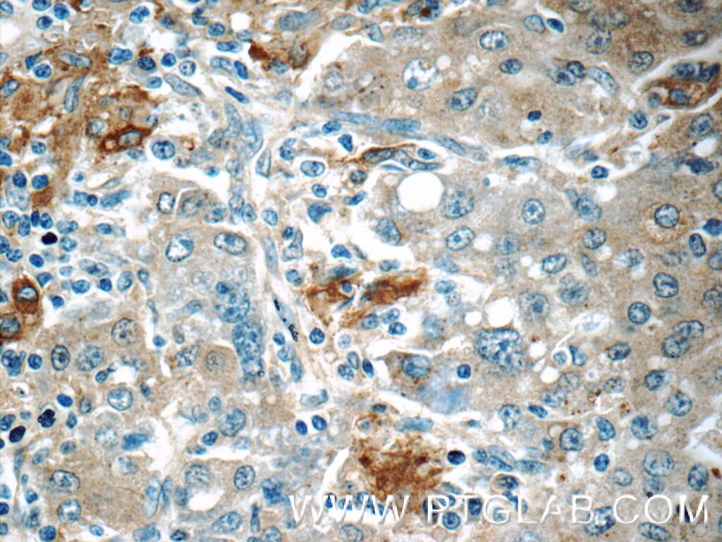 Immunohistochemistry (IHC) staining of human liver cancer tissue using COPE Polyclonal antibody (11457-1-AP)