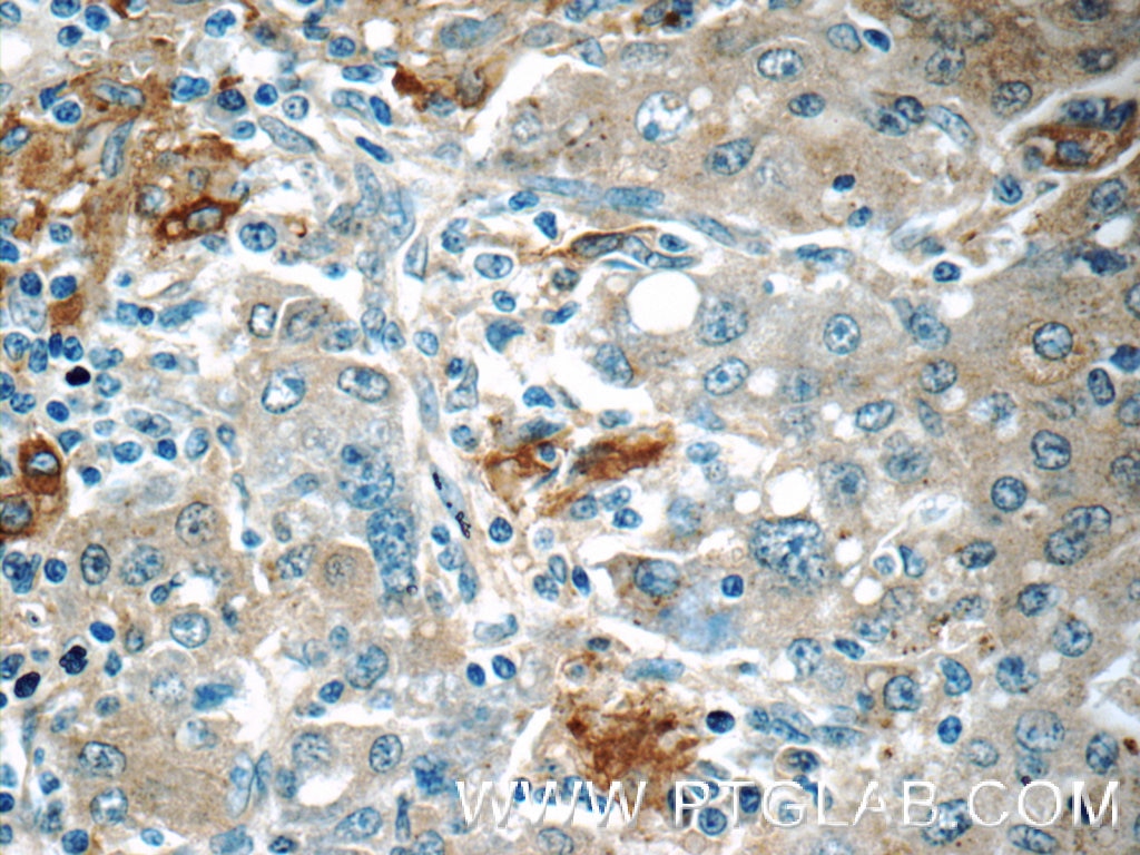 Immunohistochemistry (IHC) staining of human liver cancer tissue using COPE Polyclonal antibody (11457-1-AP)