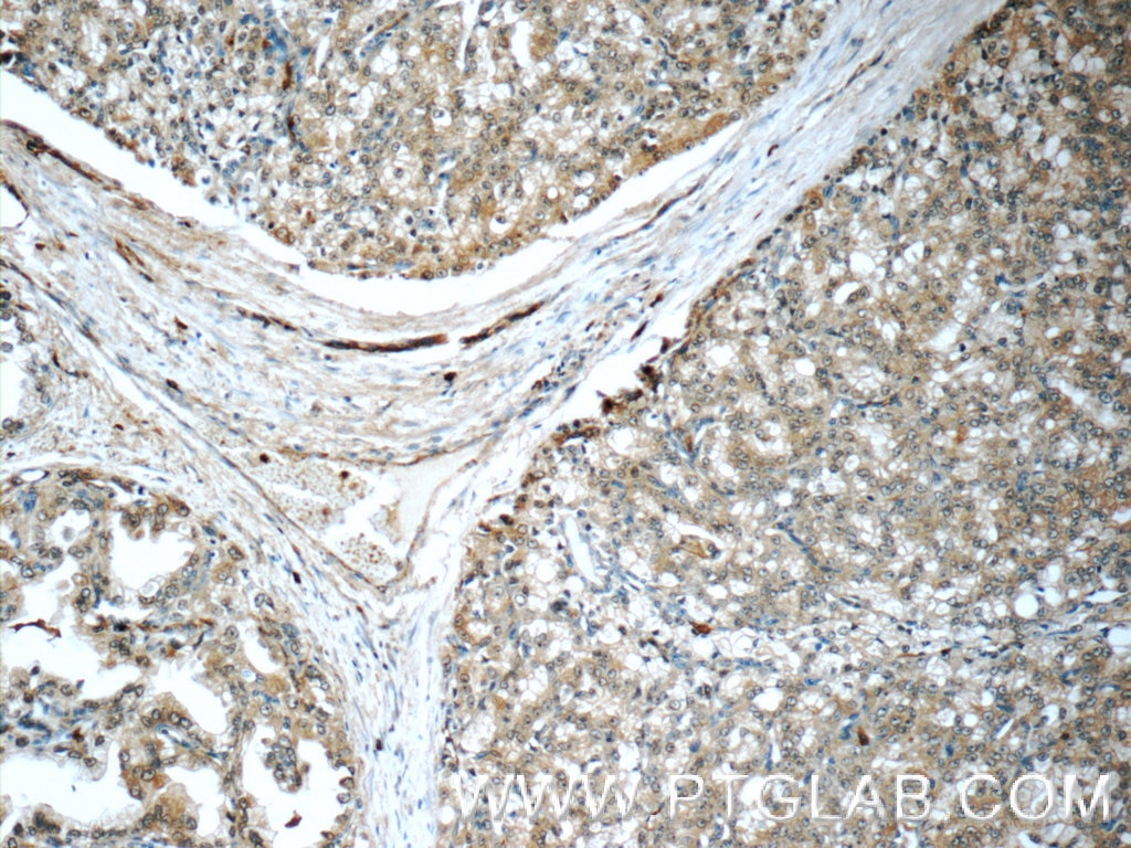 IHC staining of human prostate cancer using 11457-1-AP