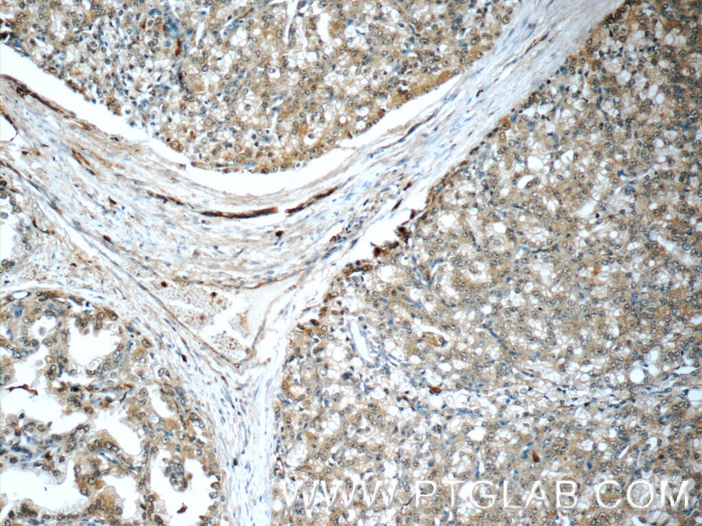 Immunohistochemistry (IHC) staining of human prostate cancer tissue using COPE Polyclonal antibody (11457-1-AP)